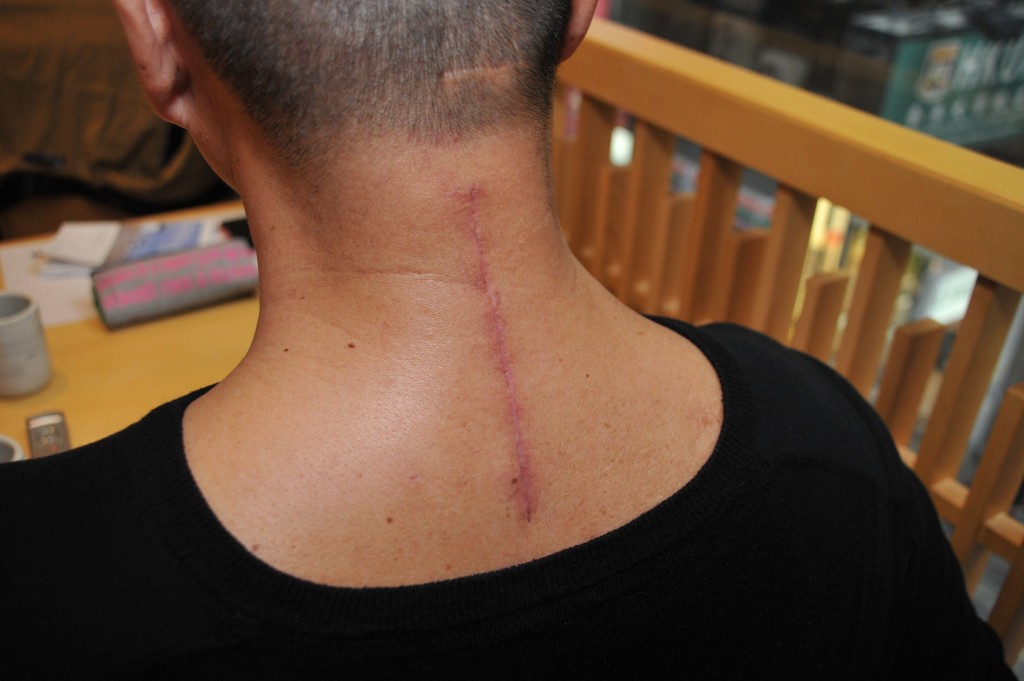 11年前鄧達智曾接受頸椎手術，留下7吋傷疤。