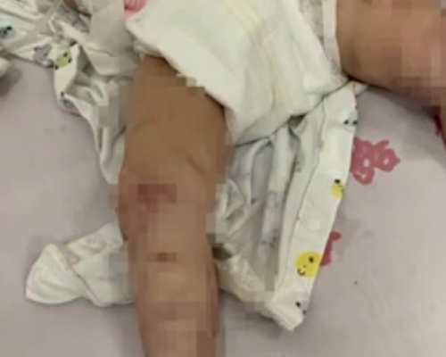 黃男童遭親生母親虐打,滿身傷痕,被送入深切治療部搶救。網圖
