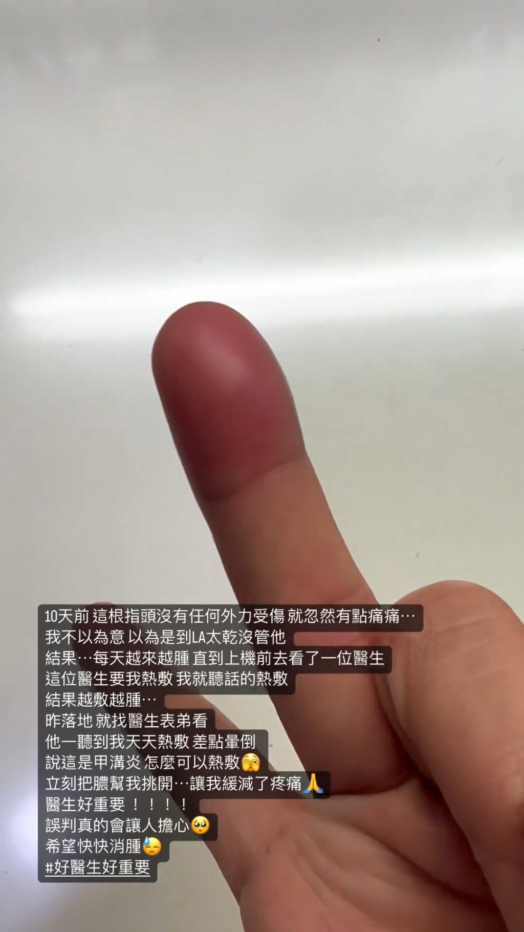 成隻手指腫到似想爆開​，已經發紫。  ​