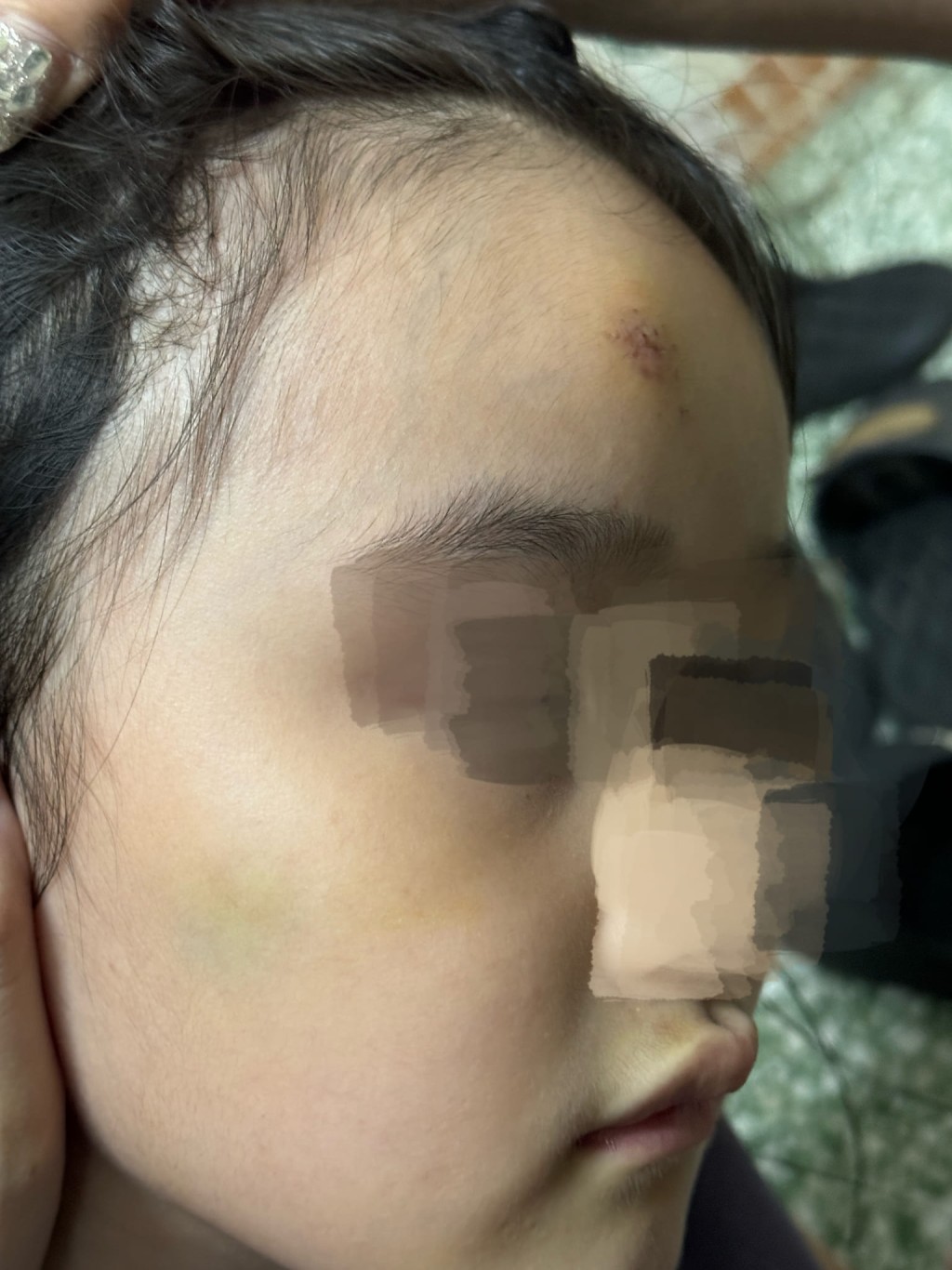 女童额头受伤。网上图片