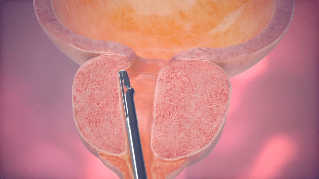手術將增生的前列腺組織拉開並固定。
