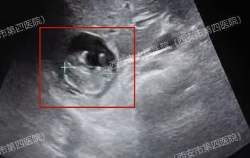 西安有婦人出現極罕有的「肝臟妊娠」需緊急終止懷孕保命。起點新聞