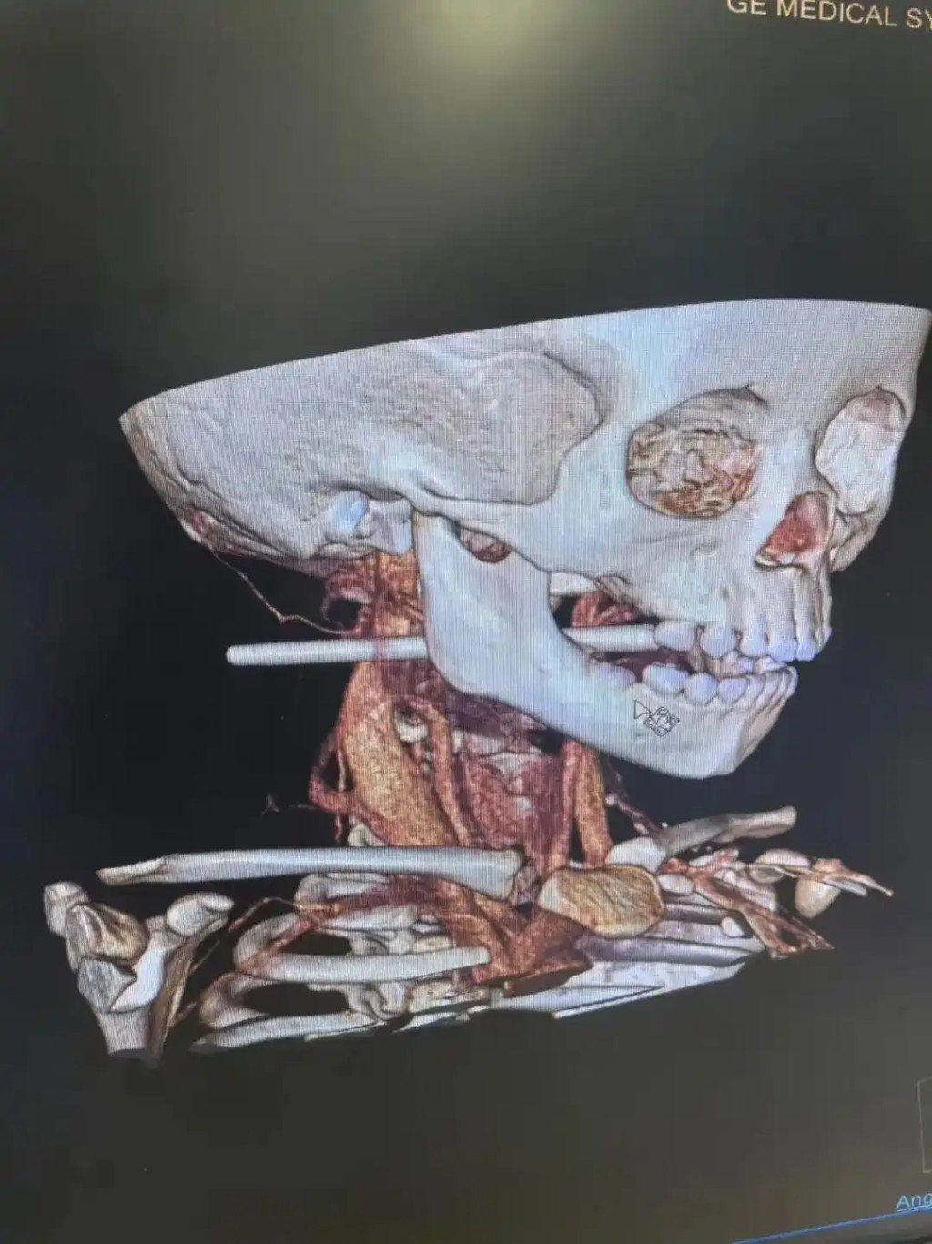 江蘇2歲女童意外遭筷子插喉,離頸動脈僅2毫米險死。 江蘇2歲女童意外遭筷子插喉,離頸動脈僅2毫米險死。