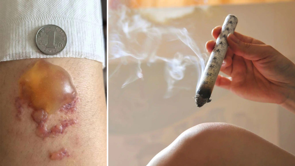 女子做艾灸致三度燒傷,水泡大過硬幣。