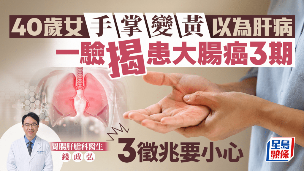 40歲女手掌變黃以為肝病 一驗揭患大腸癌3期 3徵兆要小心