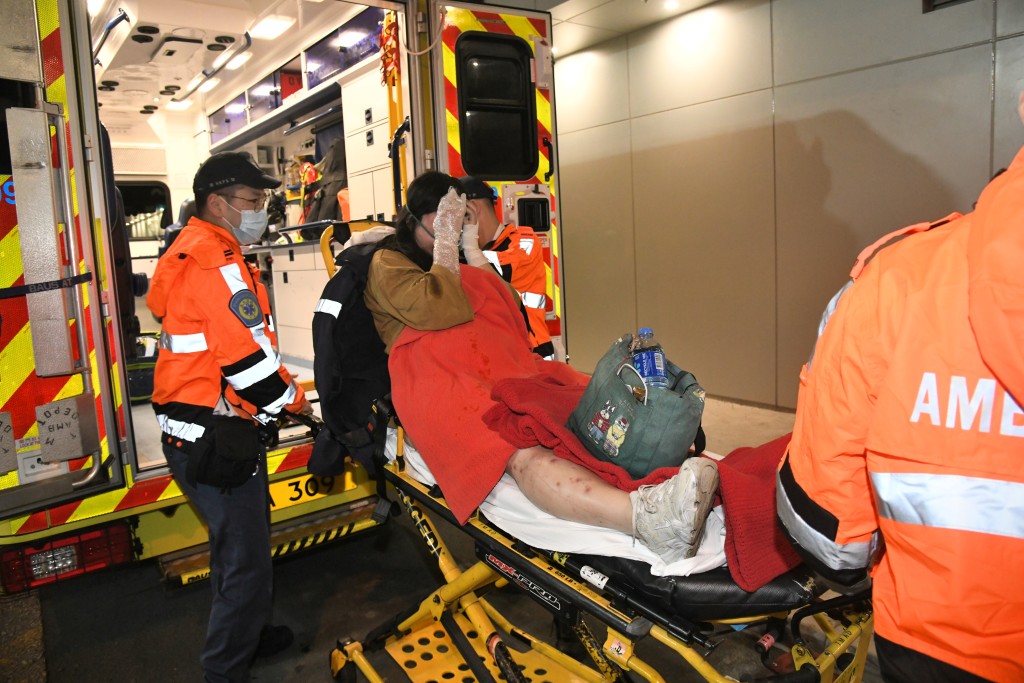 女戶主手部二級燒傷送院。蔡楚輝攝 女戶主手部二級燒傷送院。蔡楚輝攝