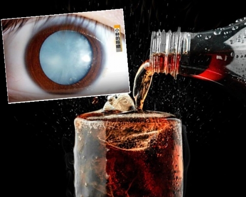 小林長期可樂當水飲，以致右眼瞳孔變成淡藍色，接近完全失明。網圖
