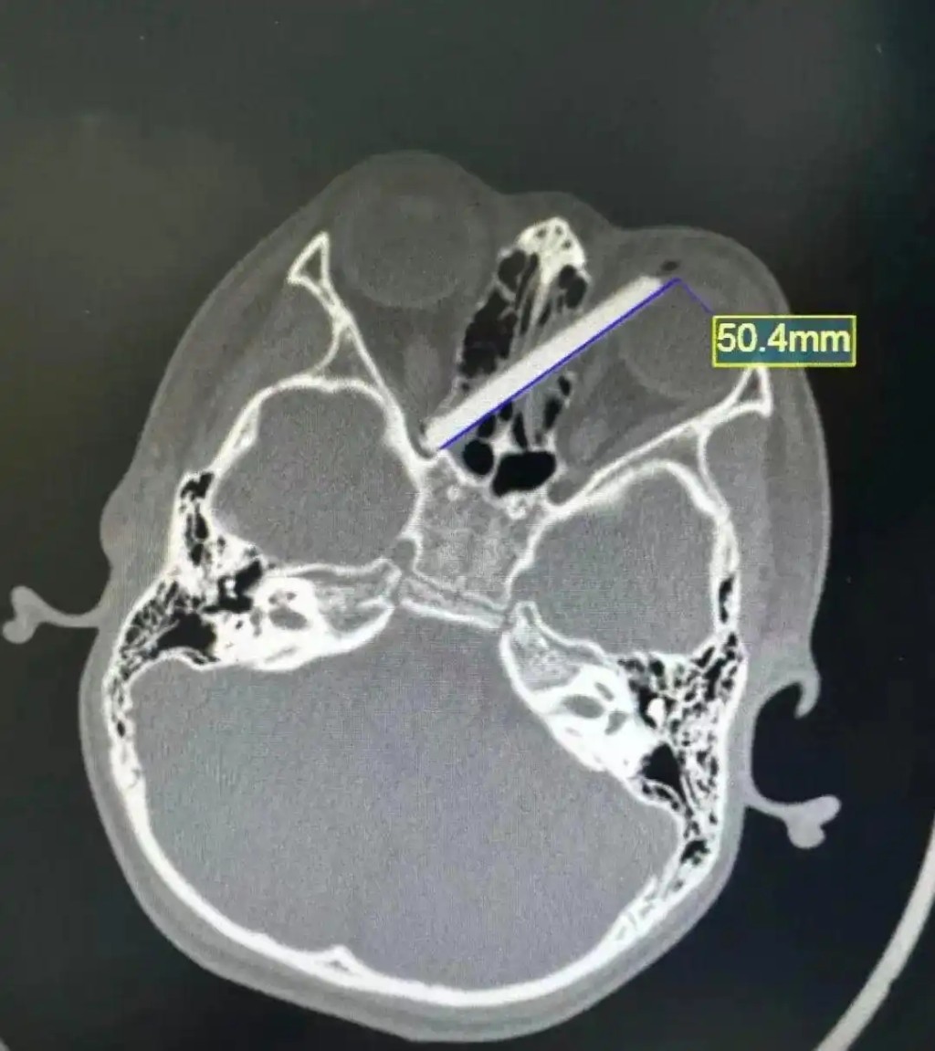 7歲童吃飯跌倒，5厘米斷筷插眼，橫貫雙側鼻竇。