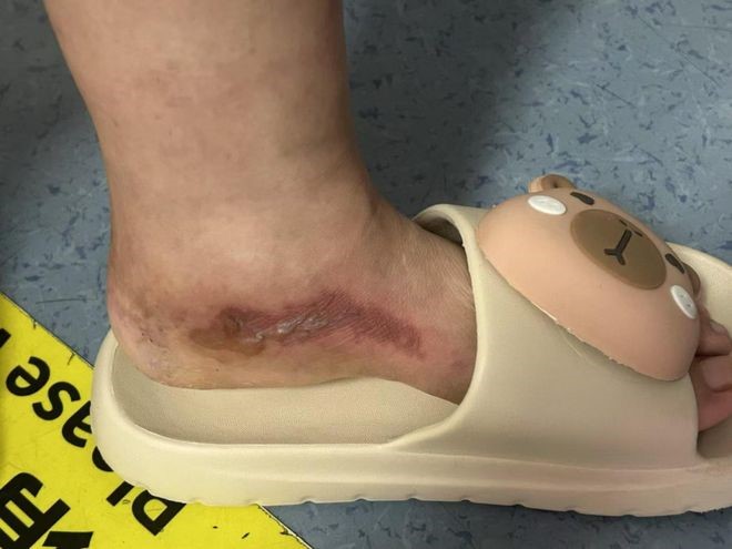 杭州有婦人為了驅蚊，把農藥「敵敵畏」噴落鞋，令雙腳長滿水泡。杭州綜合頻道