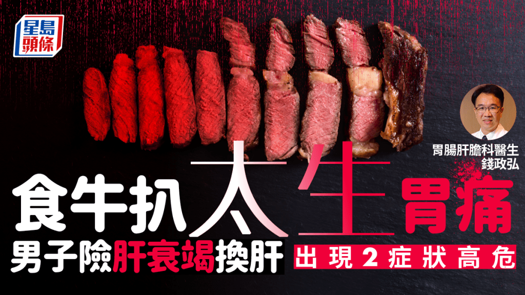 男子食牛扒太生胃痛險換肝，醫生揭出現2症狀最高危