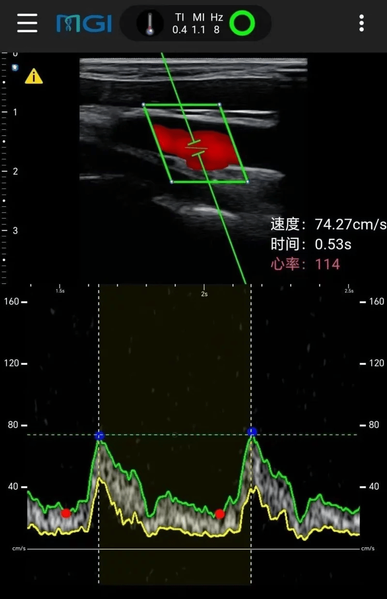在珠峰顶实时获取的颈动脉超声波扫瞄图像。