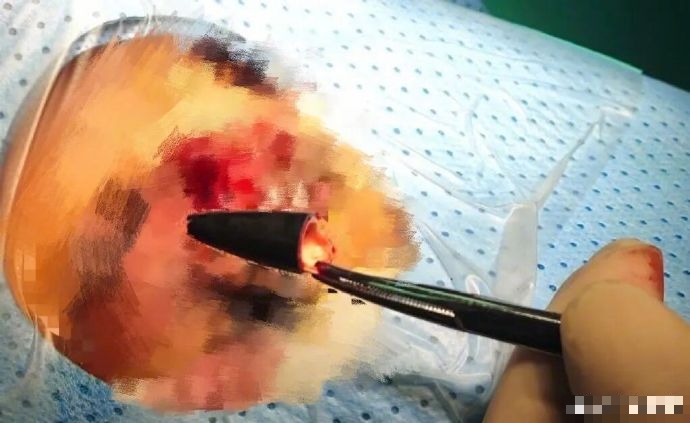 深圳男子眼痛就医，竟从眼眶内取出2.5厘米笔头。