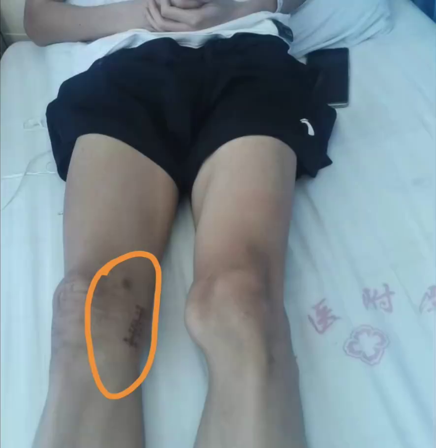 當事人手術後腳部照片，右腳留有開過刀痕跡。