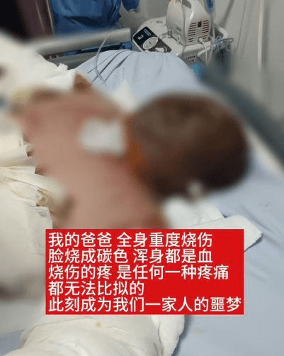 童瑤父親嚴重燒傷。