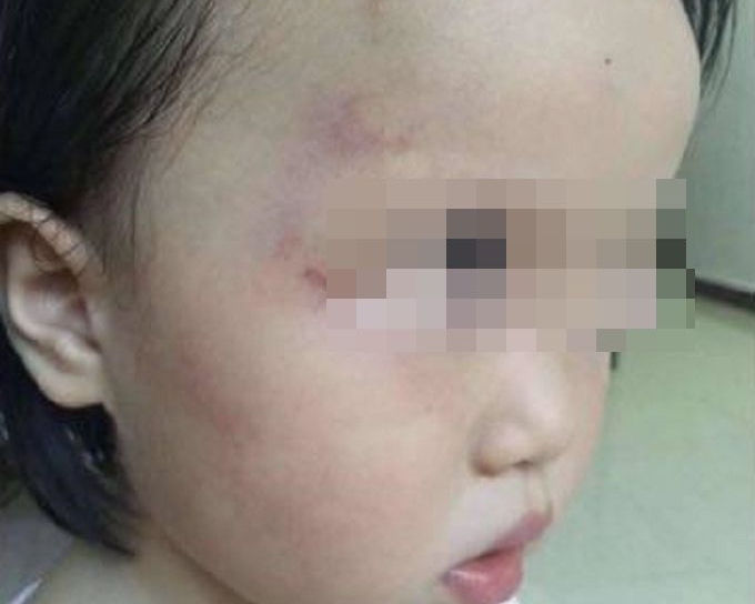 廣州一名2歲女童因在幼兒園不按時午睡，遭班主任毆打，導致頭部、臉部及大腿多處受傷。網圖