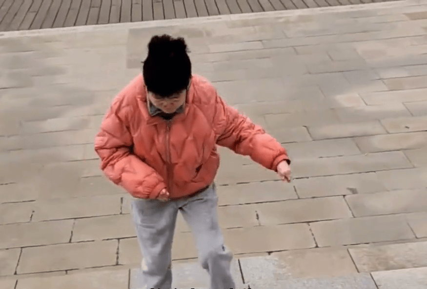 高尚好是內地首位接受分指手術的「蝴蝶寶貝」。 高尚好是內地首位接受分指手術的「蝴蝶寶貝」。