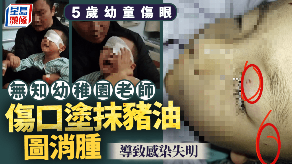 5歲童幼稚園傷眼  無知老師塗豬油致感染失明  正確急救方法為何？