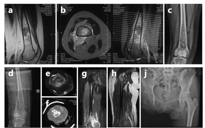 夏夏在高考結束後去醫院，被確診骨癌。