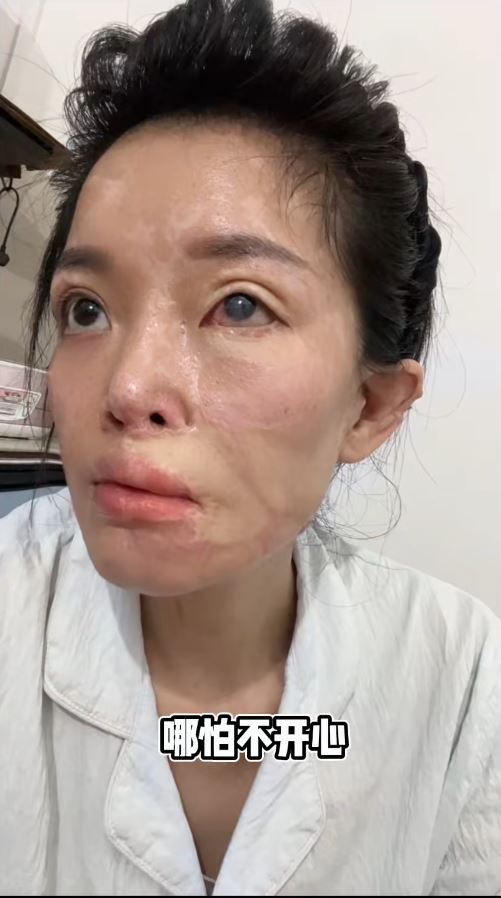 小兰被韦东传毁容及伤至双手失去生活能力。