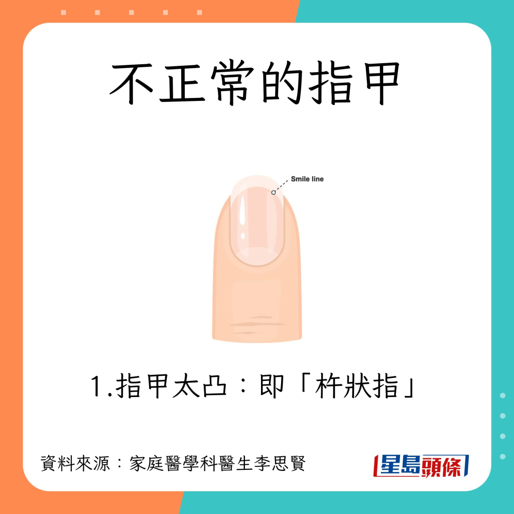 不正常指甲:杵狀指