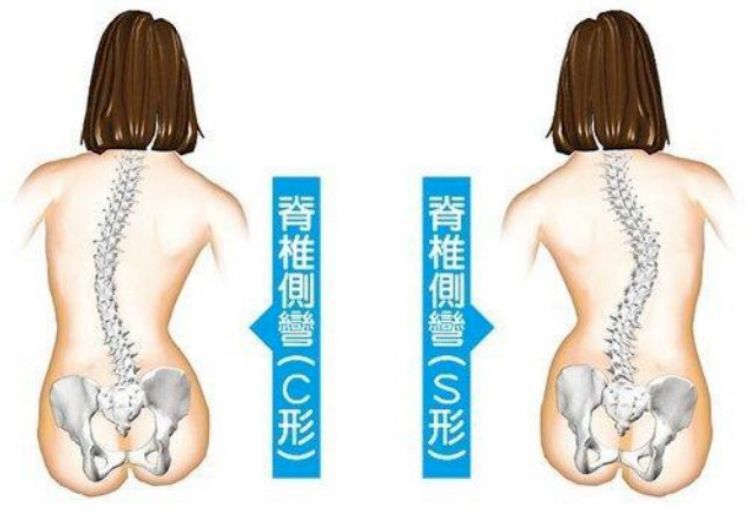 S型和C型脊椎側彎。圖片由筆者提供