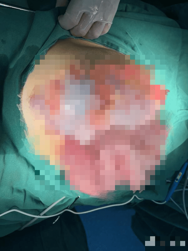 醫生指患者整個腸子在肚子裡面,盤起來的就像一個蟒蛇一樣。 醫生指患者整個腸子在肚子裡面,盤起來的就像一個蟒蛇一樣。