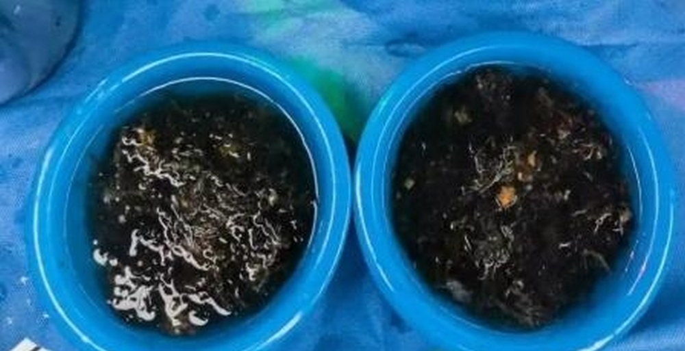 醫療團隊從女童胃中清理出兩大盆頭髮。 杭州日報