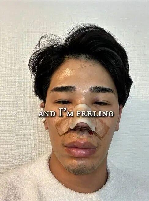 日丑男被骂“猪狒狒”饱受欺凌,狂操肌兼整容逆袭成“神户型男”。 日丑男被骂“猪狒狒”饱受欺凌,狂操肌兼整容逆袭成“神户型男”。