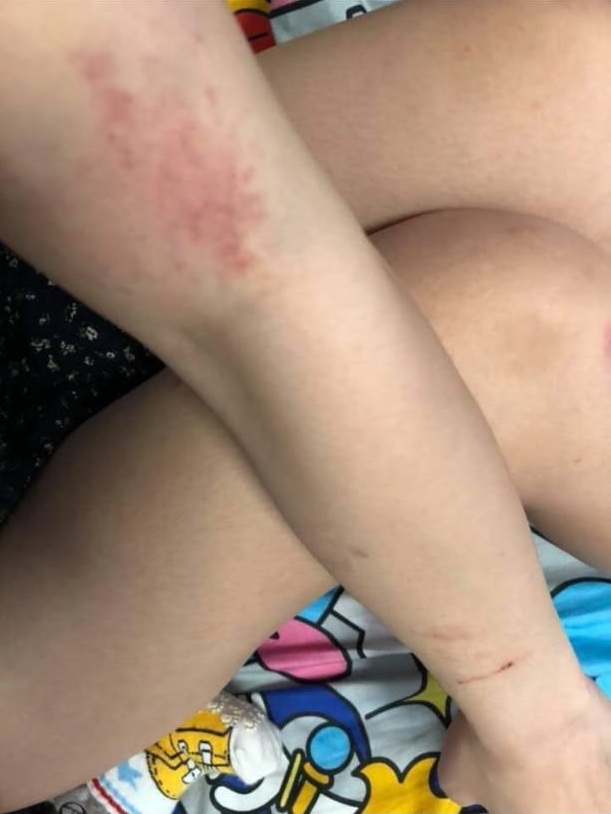 陳小姐常被鄭男家暴，手腳滿是瘀傷。(被訪者提供圖片)