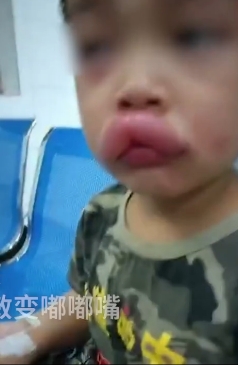 男童進食葡萄後過敏腫成性感「嘟嘟嘴」。網圖