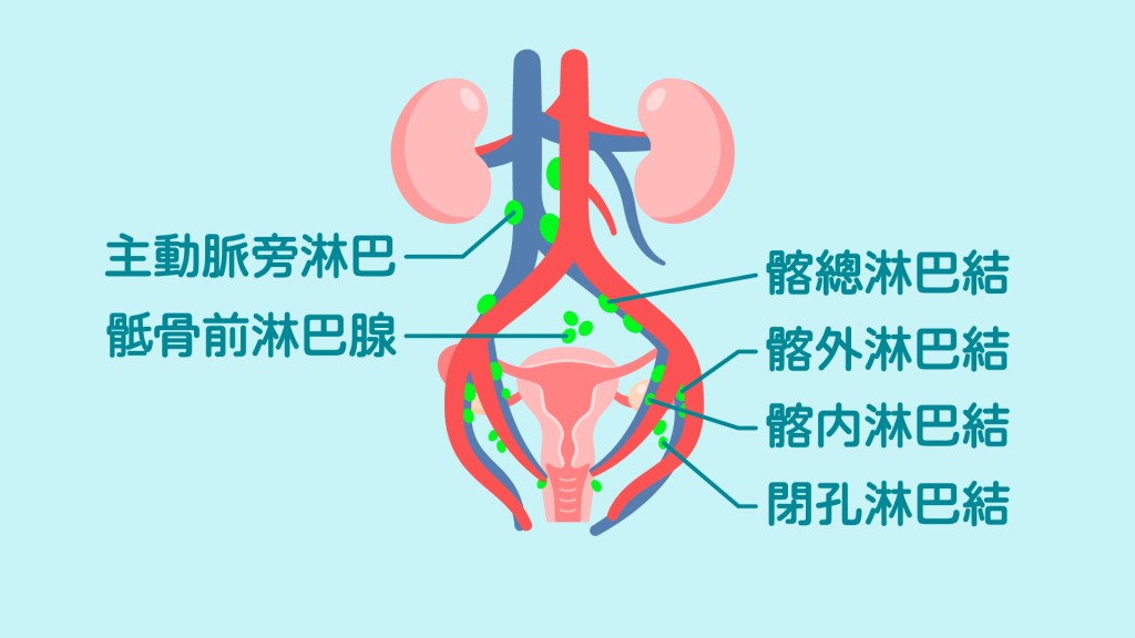 即時取出前哨淋巴去急凍化驗,看看有沒有擴散的風險。