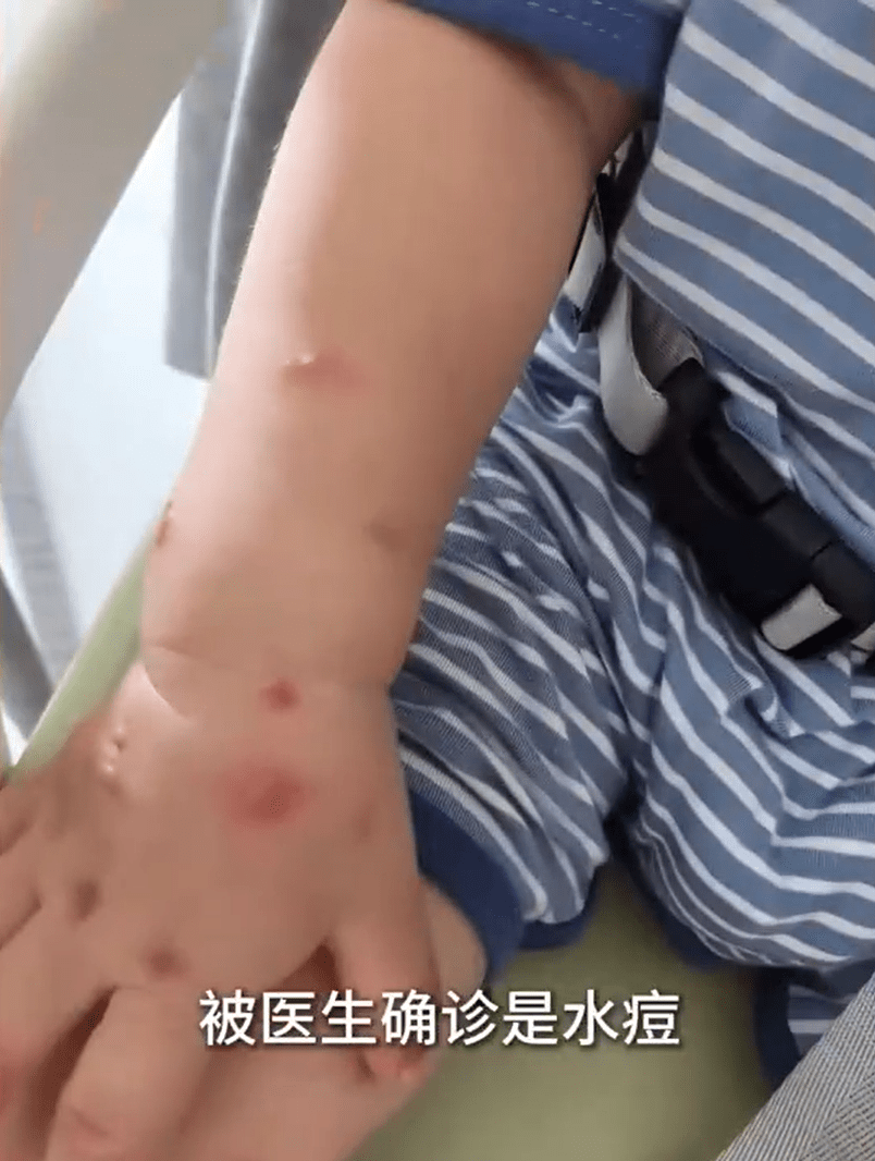 男童事後確訝水痘。 男童事後確訝水痘。
