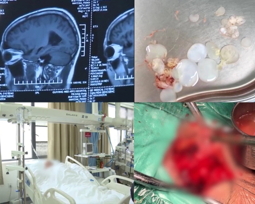 吳姓男子腦神經中布滿如葡萄串狀的腦囊蟲卵，歷經2個多小時的手術才全數清除。（網圖）