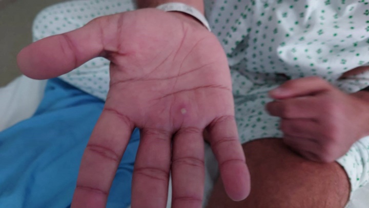 世衞至今錄得各國呈報約1.4萬宗猴痘個案。路透社資料圖片