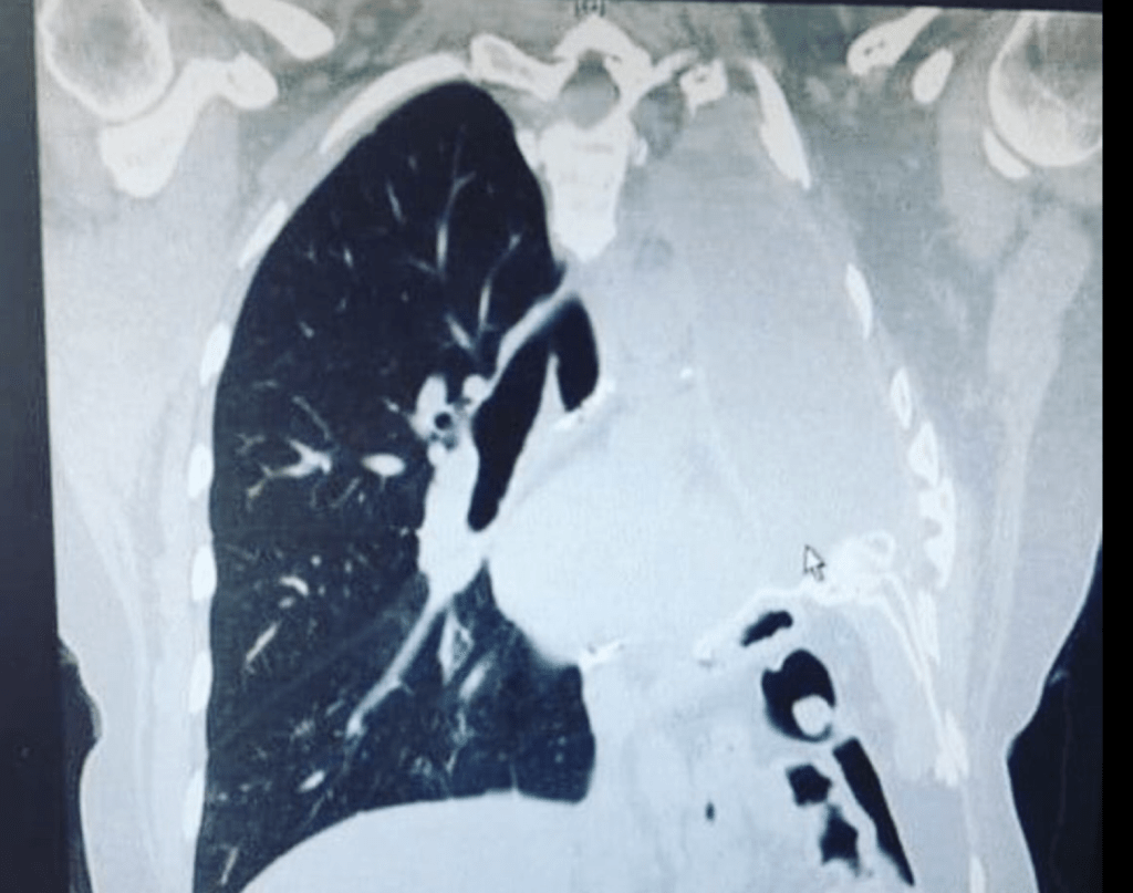 经详细检查，医院在她的肺部发现肿瘤，证实患上胸膜间皮瘤（pleural mesothelioma）。