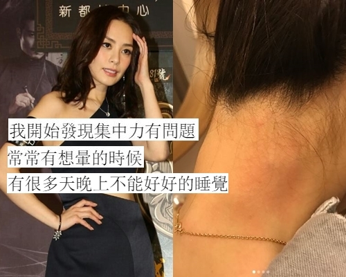 阿嬌受頸椎舊患影響，難以集中精神、睡眠質素差。
