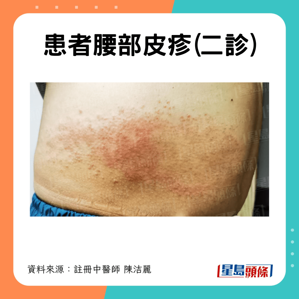 二診時腰部皮疹