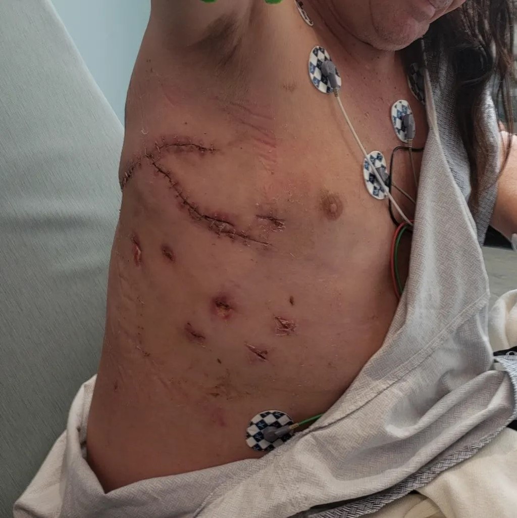 尼爾森在Facebook發布照片顯示身體右側的傷口縫線。FB圖