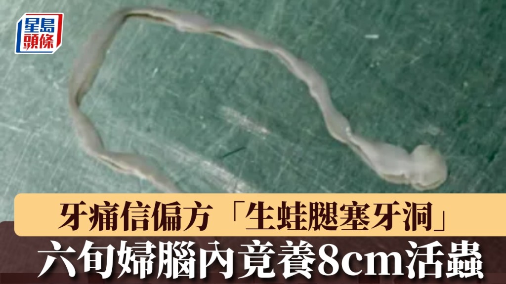 从丽姨脑袋里抓出来的活虫，已有约8cm长。