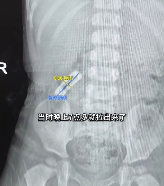 安徽有1歲女童誤吞3厘米長髮夾，靠食韭菜、金針菇成功排出體外。篝火視頻