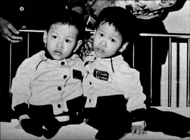 兩兄弟是罕見的「坐骨連體嬰」,出生後被母親棄養。