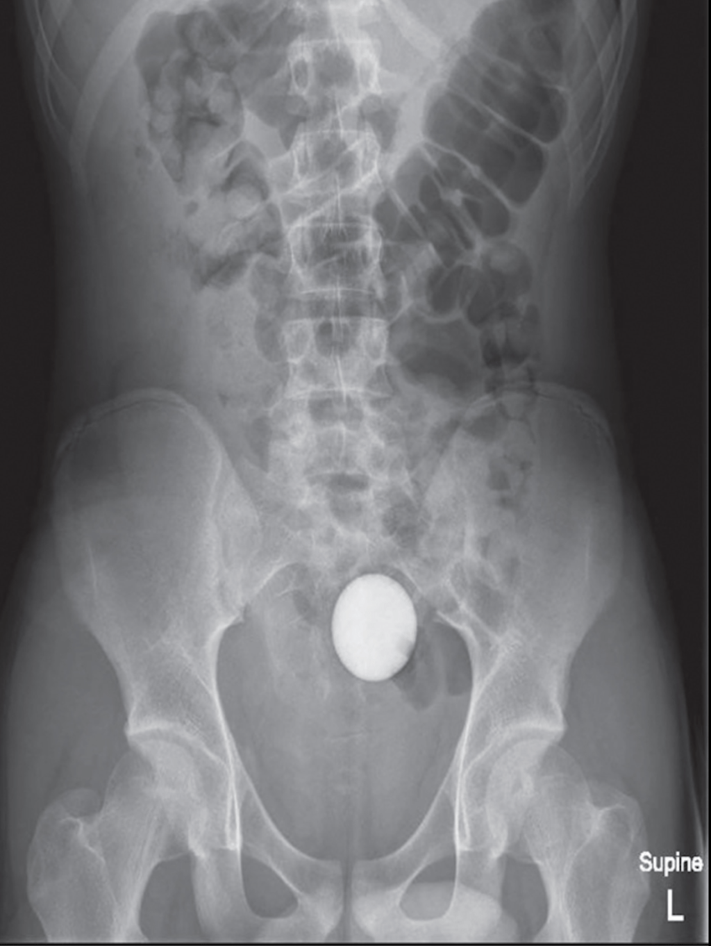澳洲少年被高尔夫球卡在体内的X光片。
