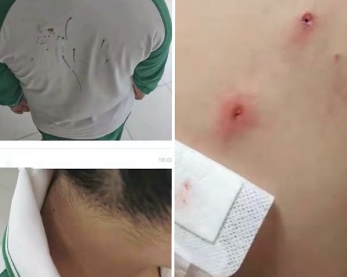 廣州一名小一生疑被同學欺凌，用鉛筆刺傷身體多處。影片截圖