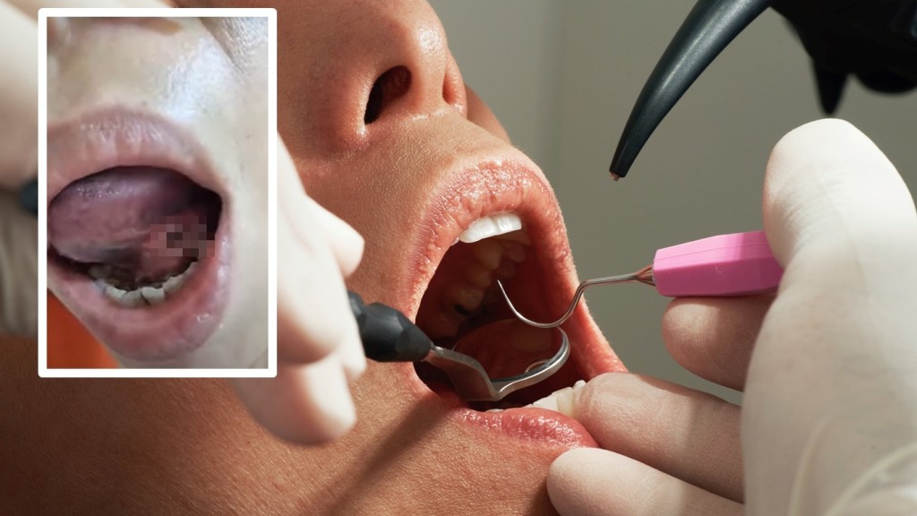 女生早前到牙醫診所拔牙，隨後竟在舌頭下發現有一個大洞。示意網圖/「爆料公社」FB