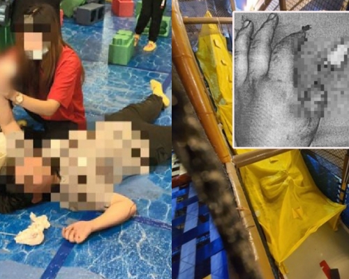 台灣10歲男童玩滑梯, 大拇指慘被尼龍繩切開兩截。
