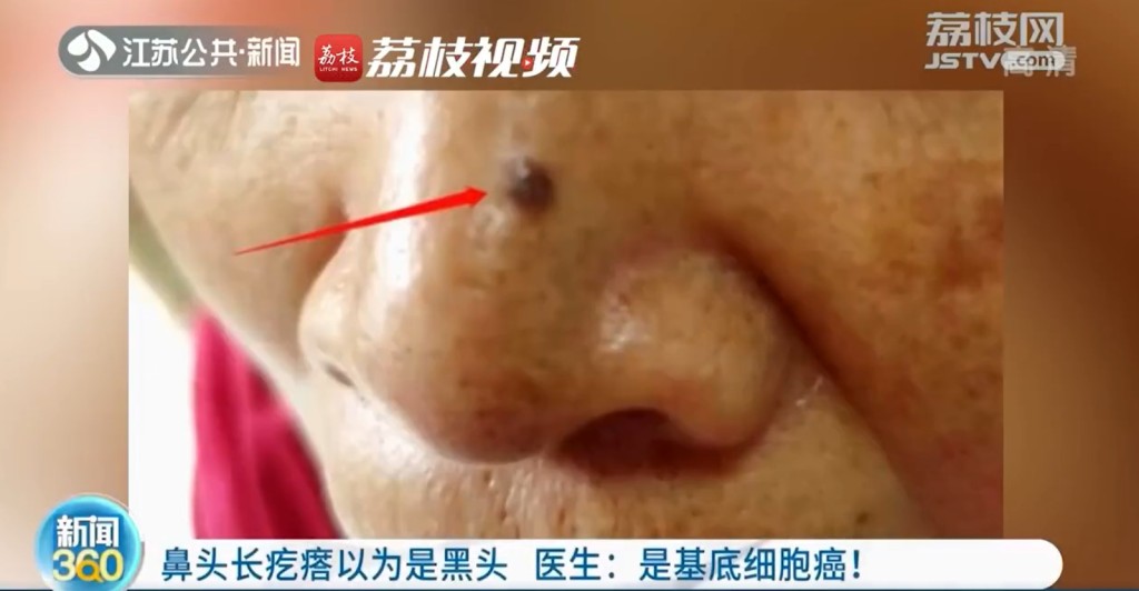 朱女士鼻上長出黑頭，求醫驚揭為「基底細胞癌」。（荔枝新聞截圖）