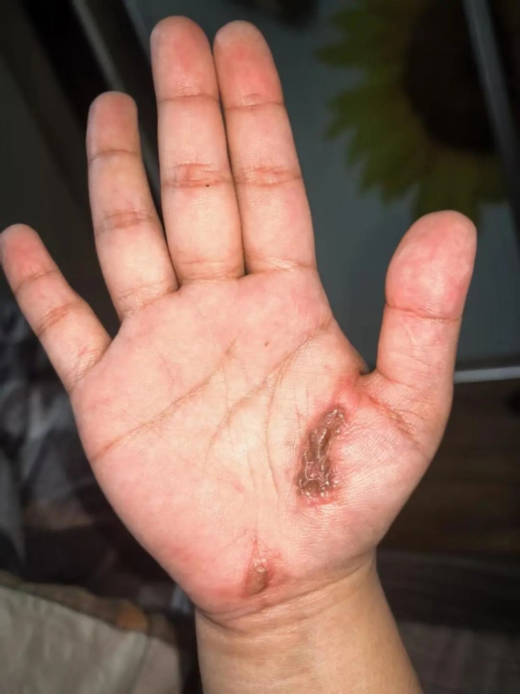 被电击女子右手掌有明显的炭黑色焦痂。 