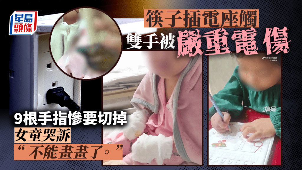 四川女童將筷子插入電座，9根手指須被切。網上圖片