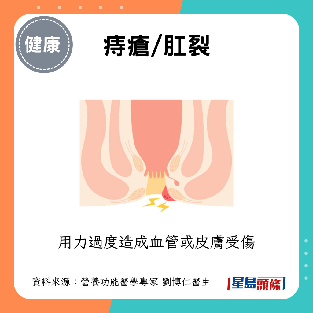 痔瘡/肛裂 痔瘡/肛裂