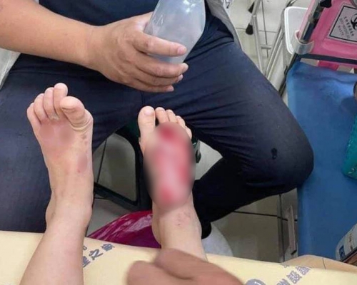 男童腳掌遭淥傷。互聯網圖片